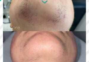 Pcos Hair Growth - How Can Laser Hair Removal Help?