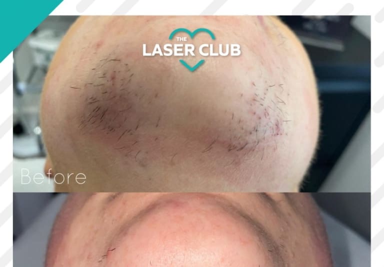 Pcos Hair Growth - How Can Laser Hair Removal Help?