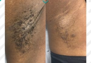 Laser Hair Removal for All Skin Types Manchester