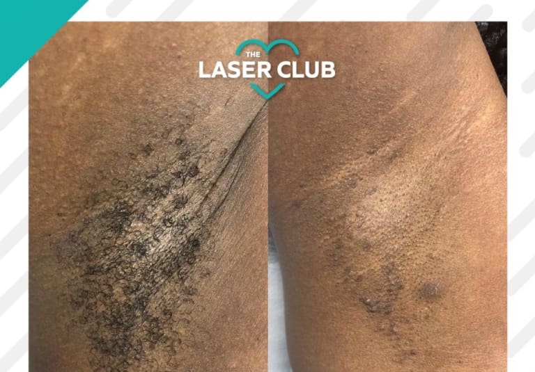 Laser Hair Removal for All Skin Types Manchester