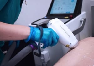 IPL or Diode Laser? Advantages of diode laser hair removal over IPL