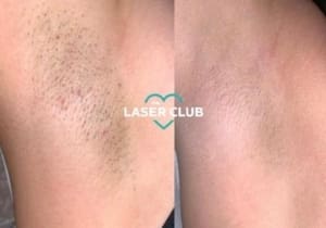 Getting Wedding Ready Laser Hair Removal Dublin