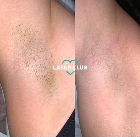 Getting Wedding Ready Laser Hair Removal Dublin