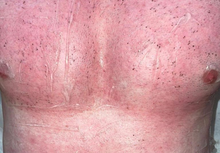 The Chest is the most Popular Area for Laser Hair Removal in Men