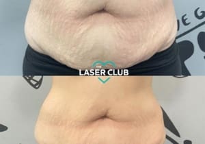 Fat Freezing with the new Cryostar Cheshire