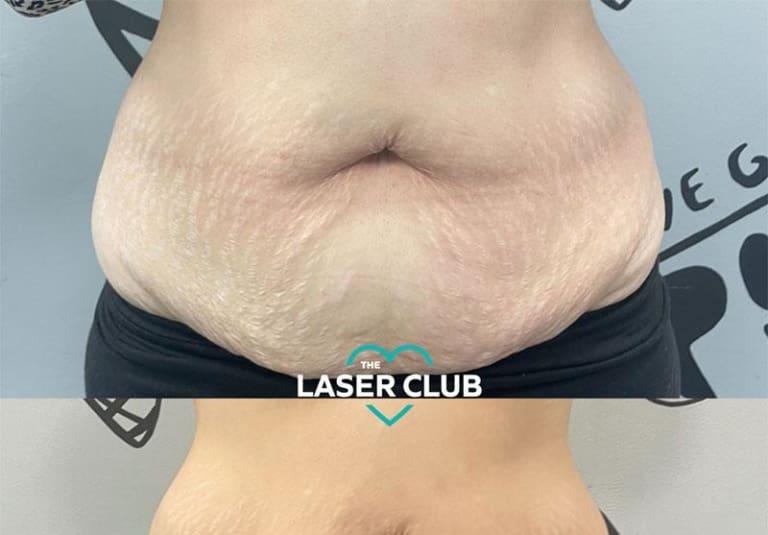 Fat Freezing with the new Cryostar Cheshire