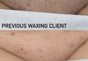 Benefits of Laser Hair Removal