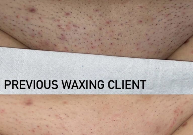 Benefits of Laser Hair Removal