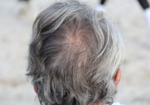 Why you must get laser hair removal before your hairs turn grey