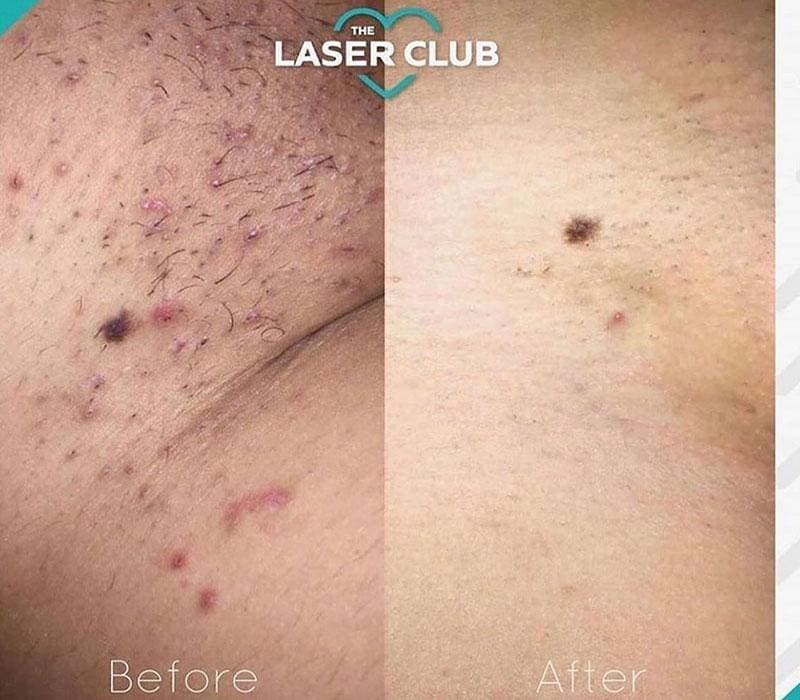 Pros & Cons of Laser Hair Removal Before and After