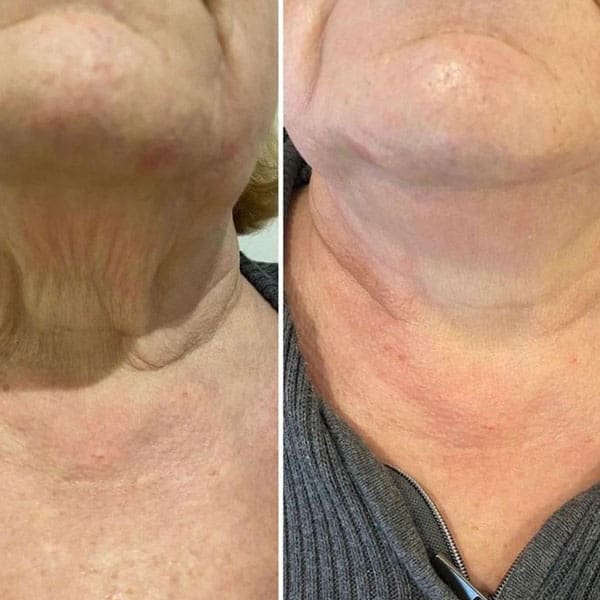 Cryofacial - Before and After 1