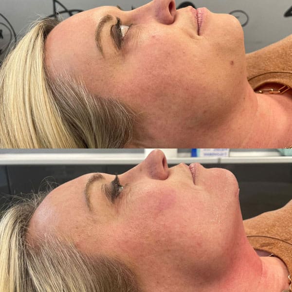Cryofacial - Before and After 2
