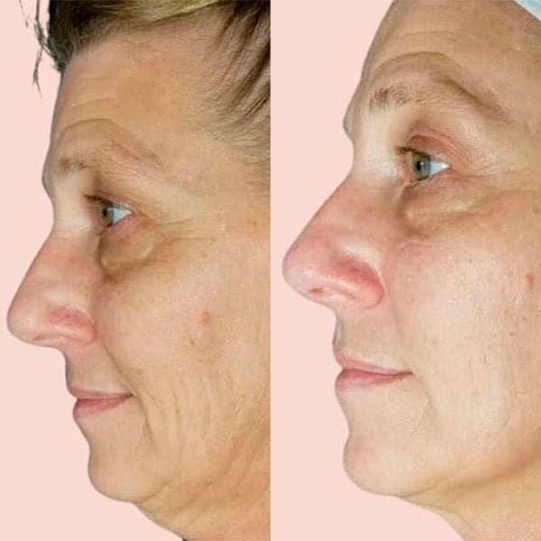 Cryofacial - Before and After 4