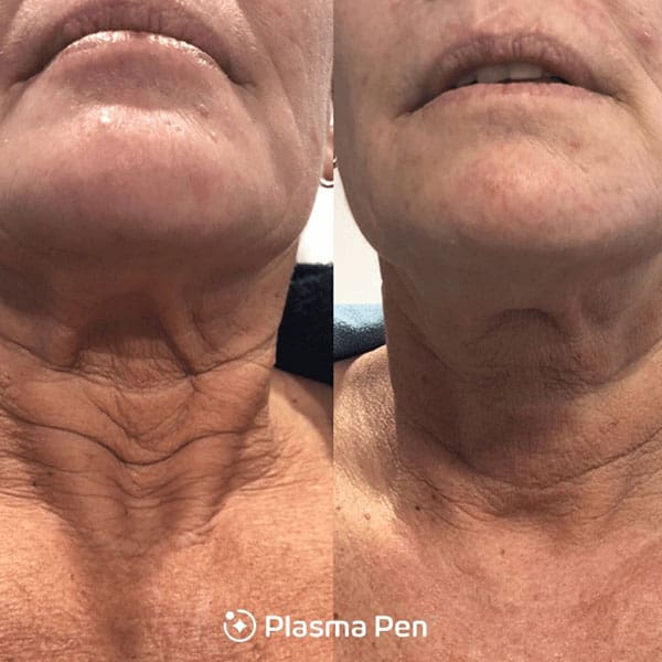 Plasma Pen - Before and After 1