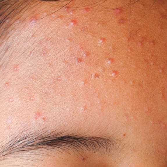 Acne