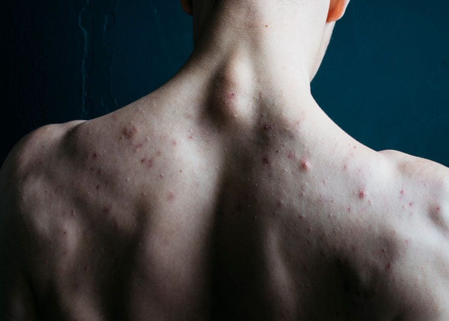 Back Acne
