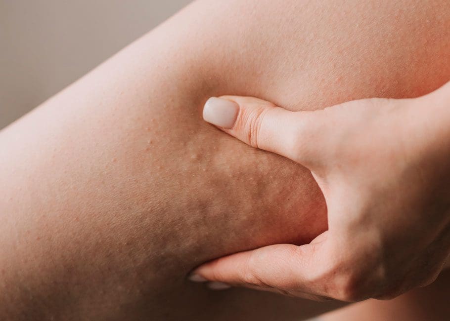 Cellulite