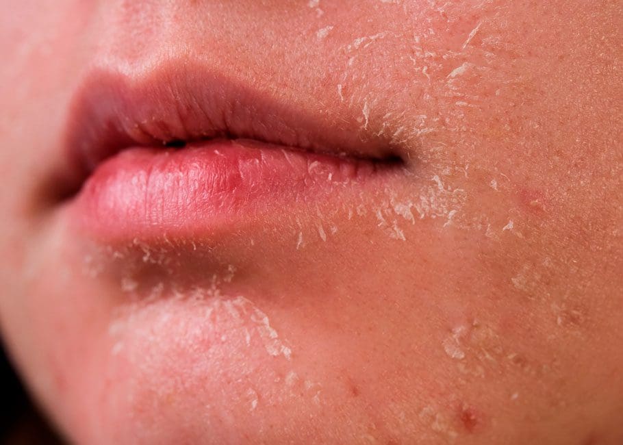 Dry Skin