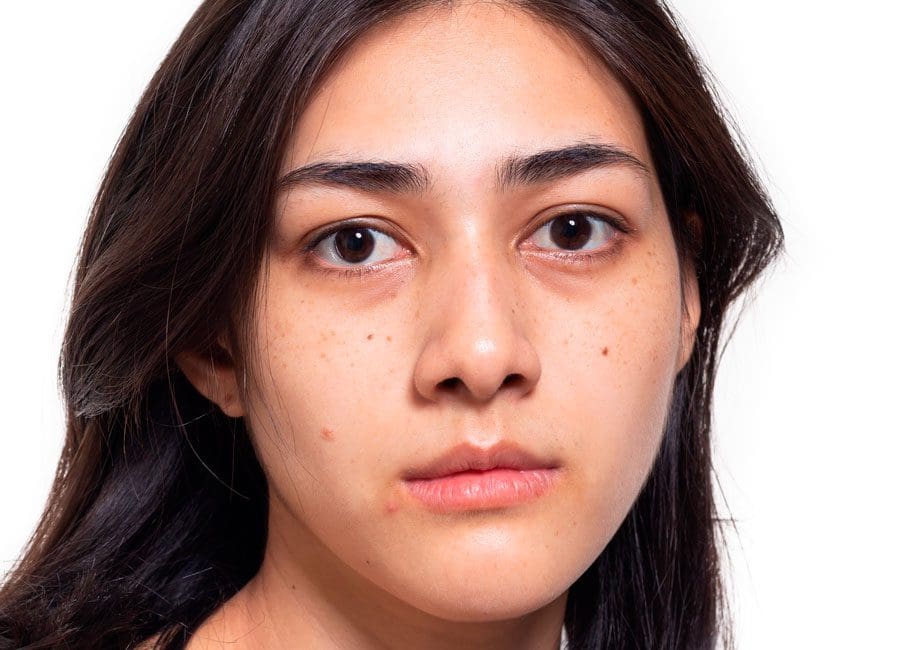 Dull Skin
