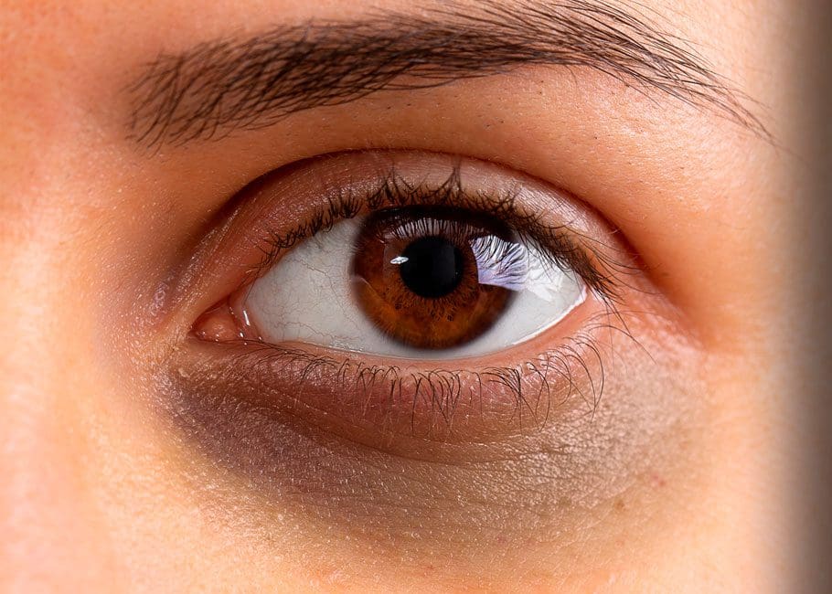 Hooded Eyes