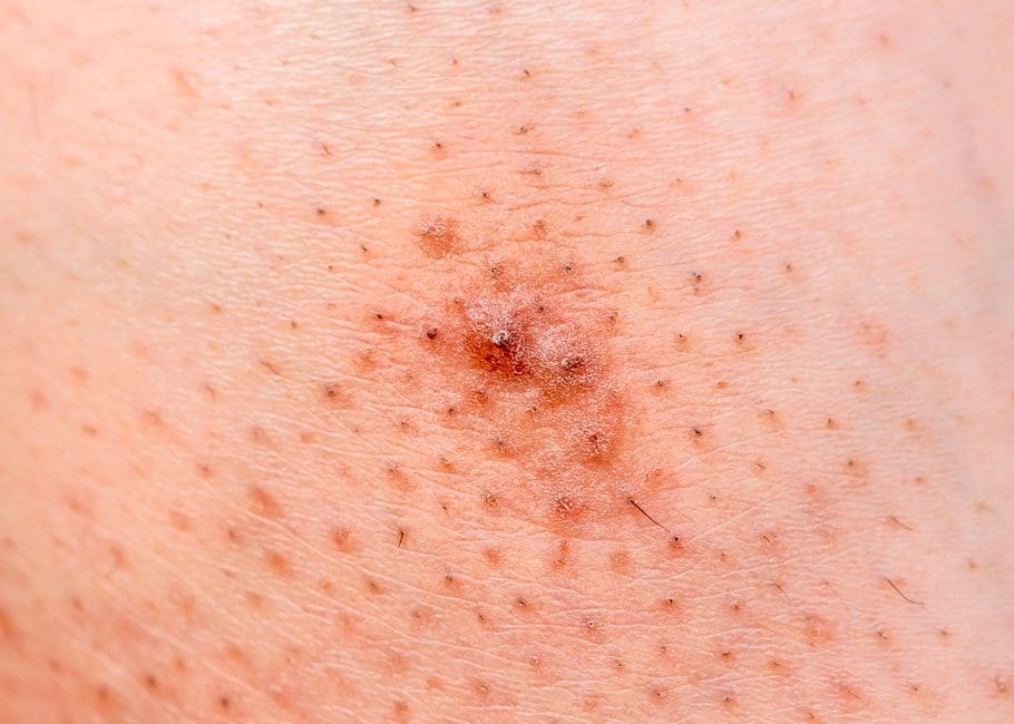 Ingrown Hair