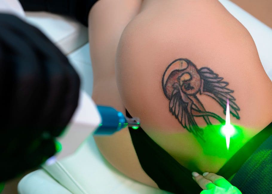 Laser Tattoo Removal