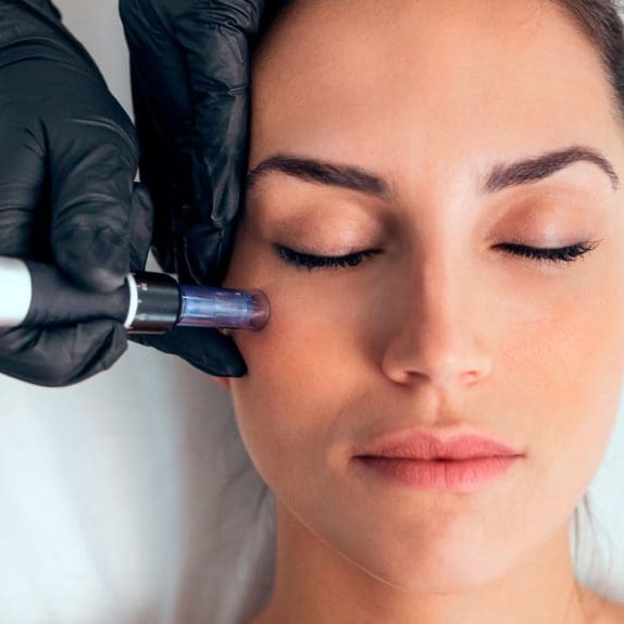 Microneedling