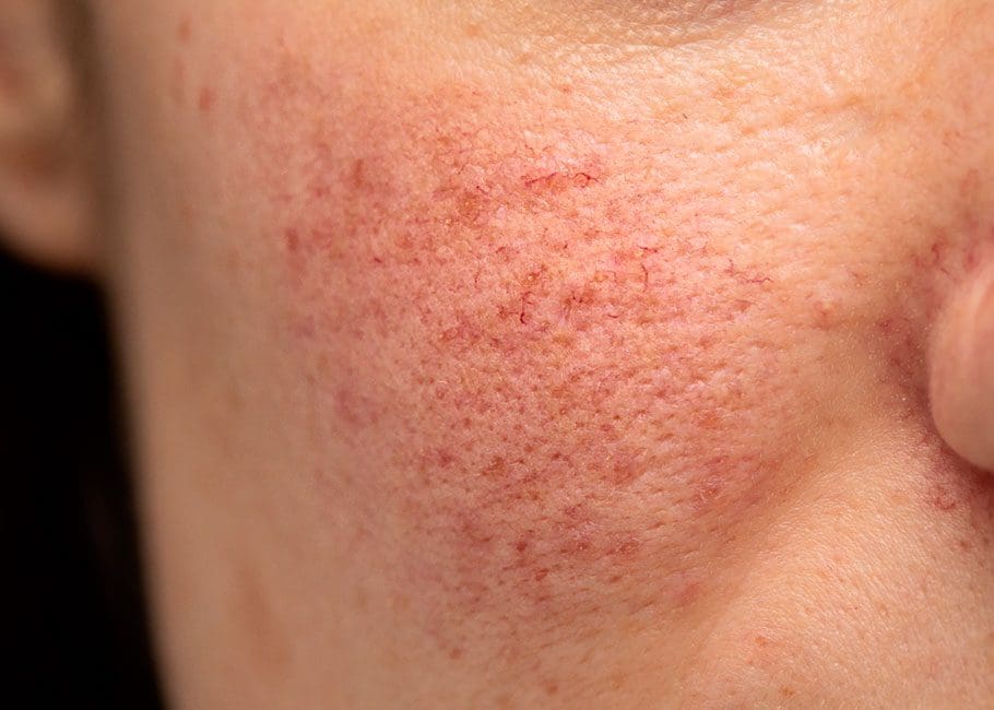 Rosacea