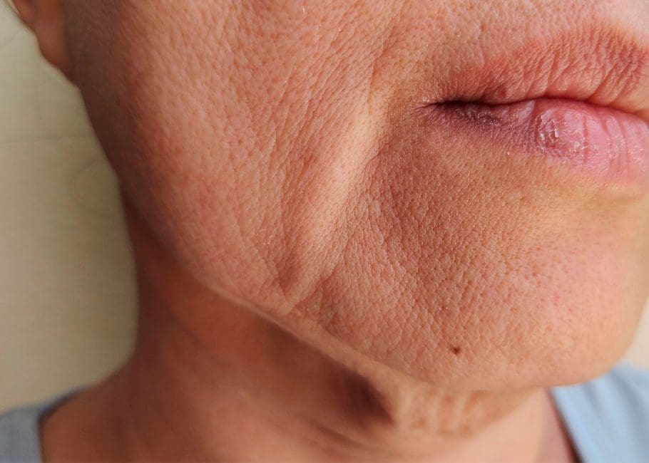 Sagging Jowls