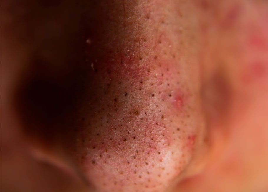 Whiteheads and Blackheads