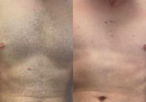 What is laser hair removal and does it work?