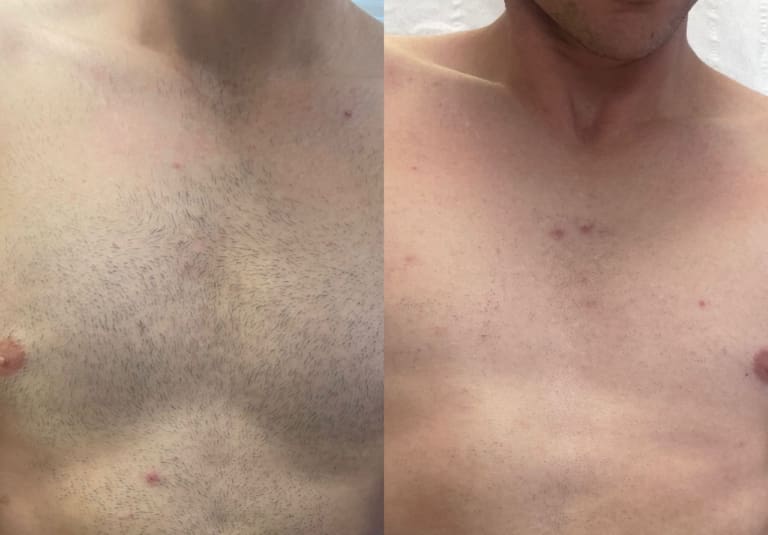 What is laser hair removal and does it work?