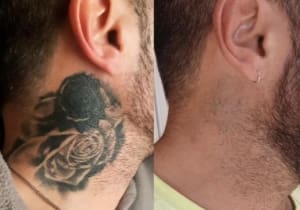 Tattoo Removal at The Laser Club