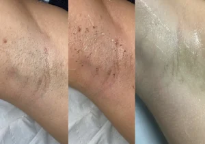 Laser Hair Removal Myth