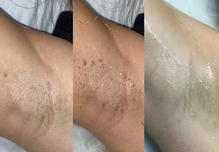 Laser Hair Removal Myth