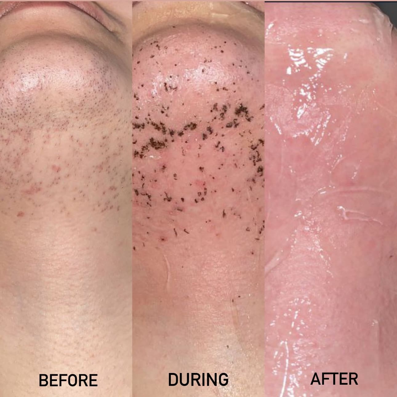 Laser Hair Removal Results