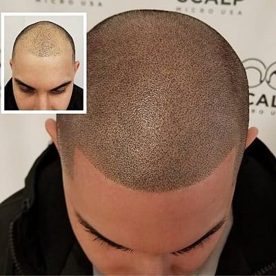Good example of scalp micro pigmentation