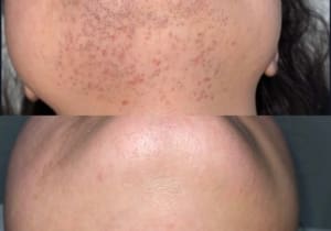 Laser Hair Removal