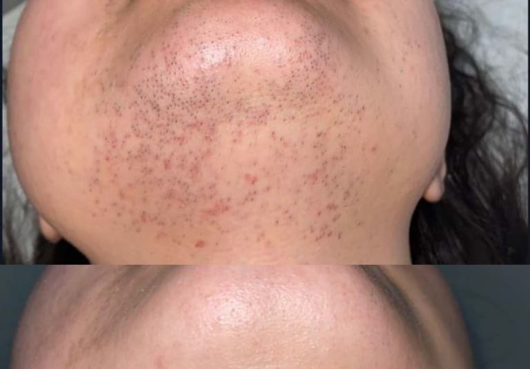 Laser Hair Removal