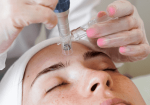 Micro-needling