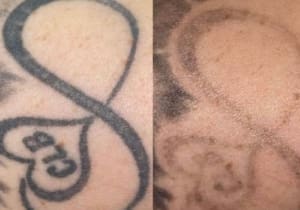 Laser Tattoo Removal