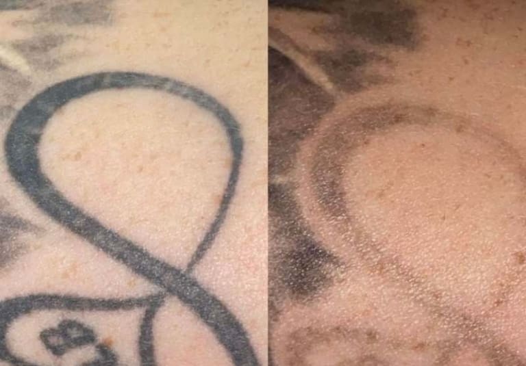 Laser Tattoo Removal