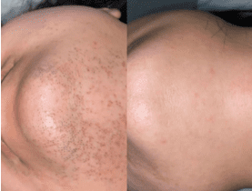 Full course of face laser