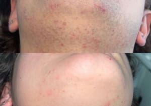 Half way through face laser course