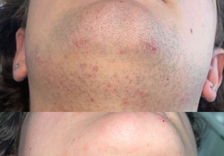 Half way through face laser course