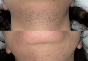Package of 6 Half Face and Neck