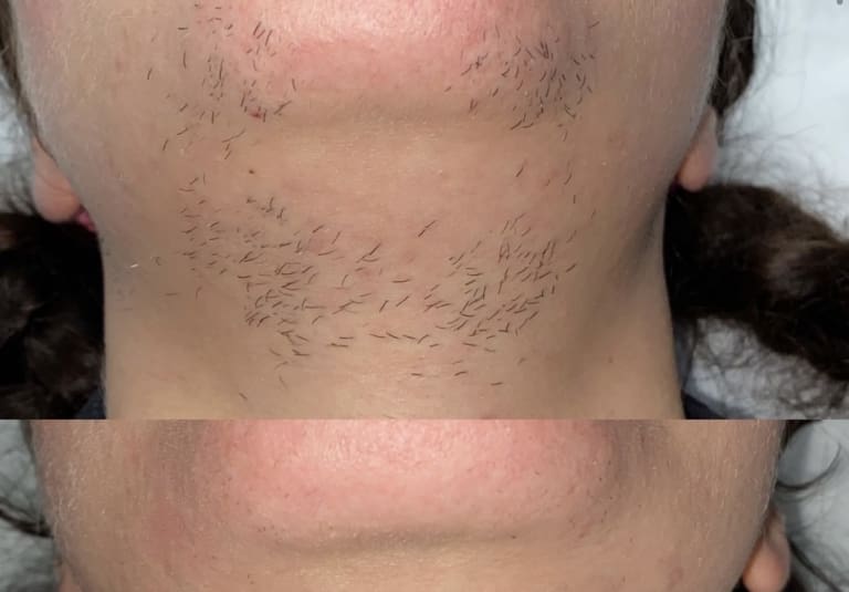 Package of 6 Half Face and Neck