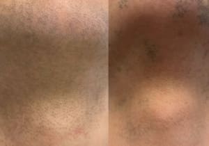 Face laser 1 session