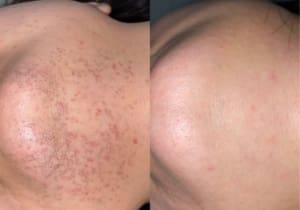 Laser Hair Removal vs Electrolysis