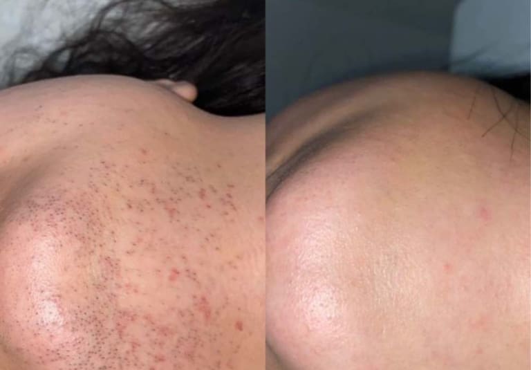 Laser Hair Removal vs Electrolysis